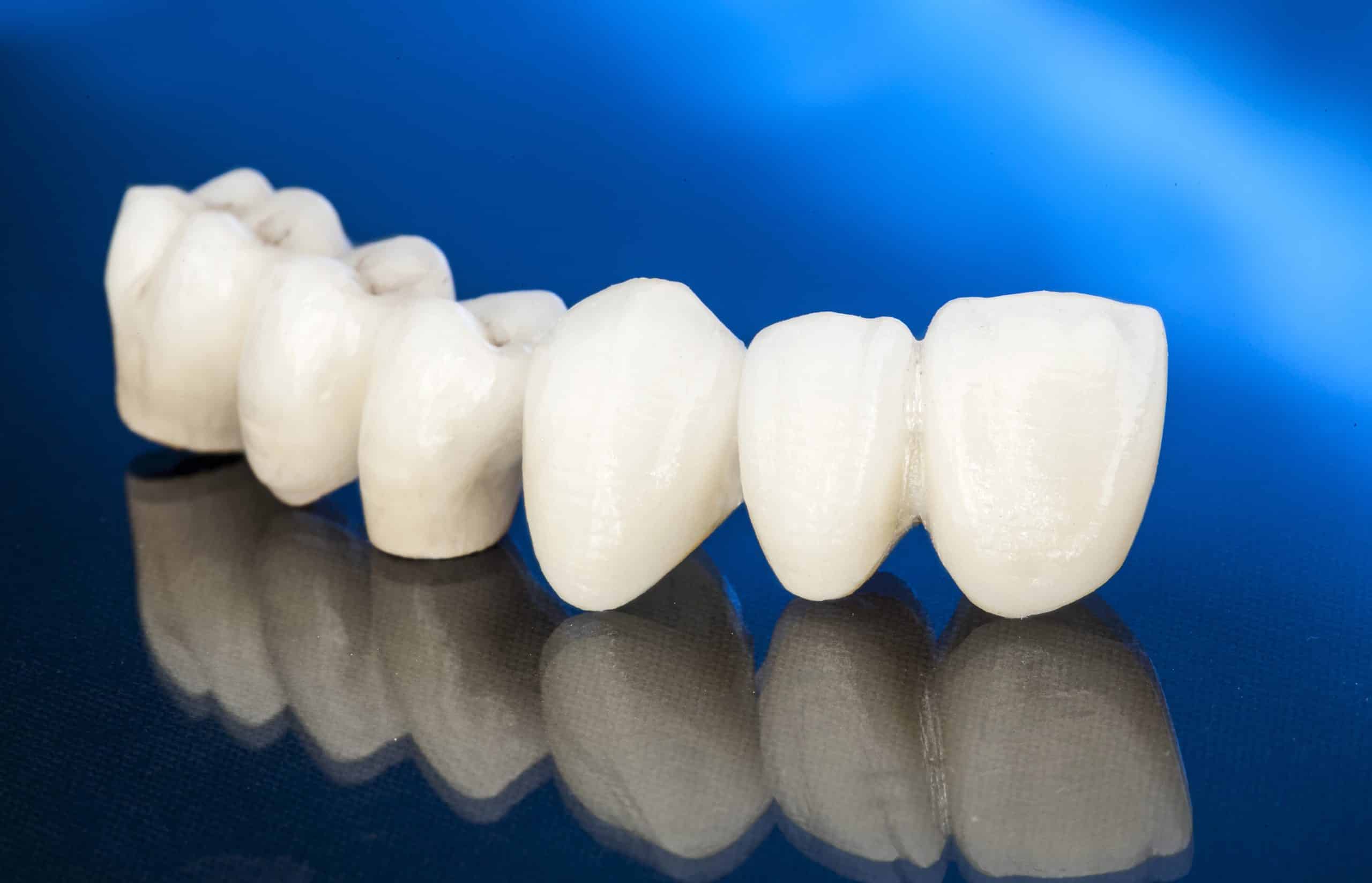Tooth Crowns and Bridges in Palm Harbor, Florida