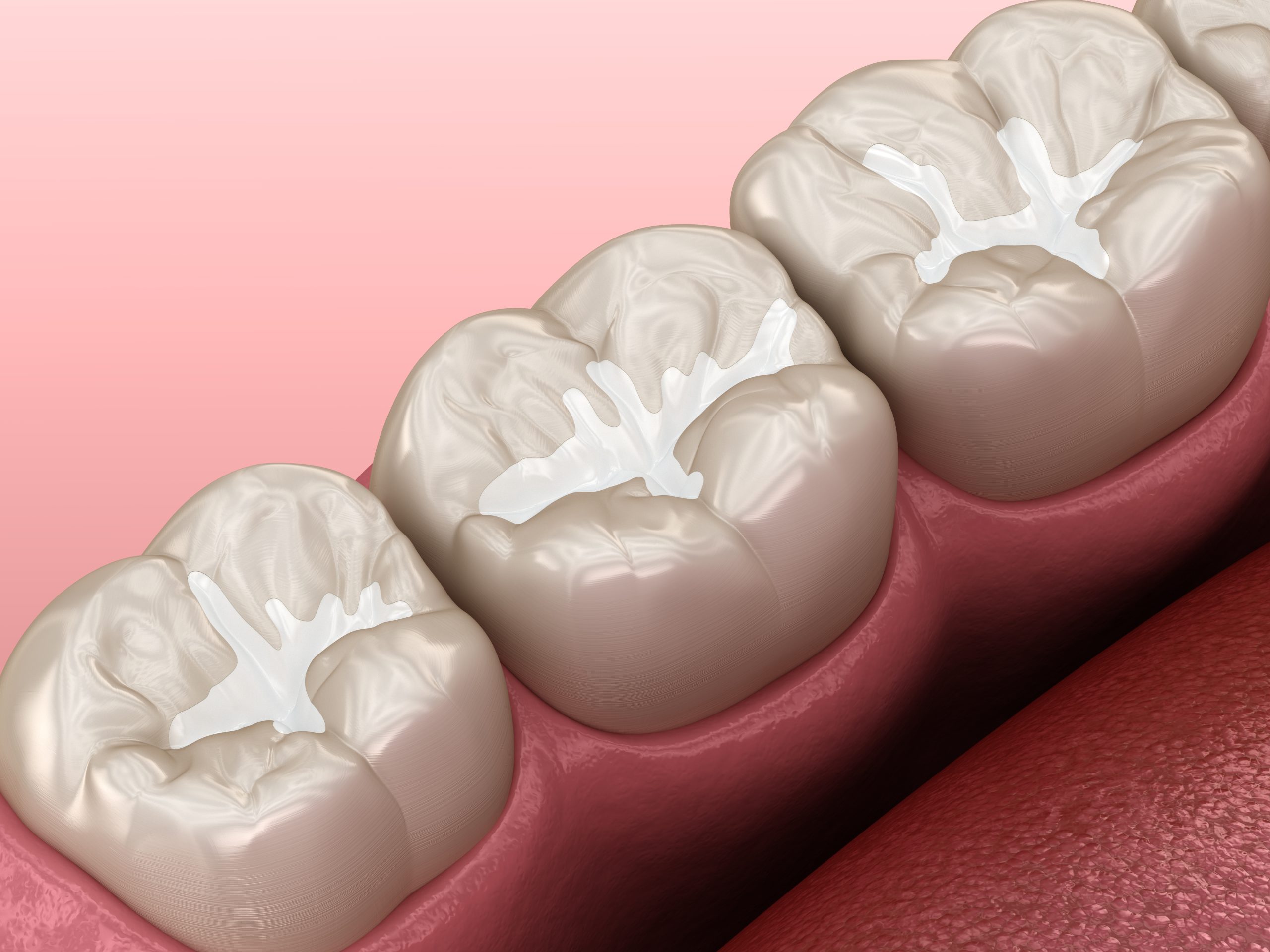 Cavity Fillings and Dental Sealants in Palm Harbor, Florida