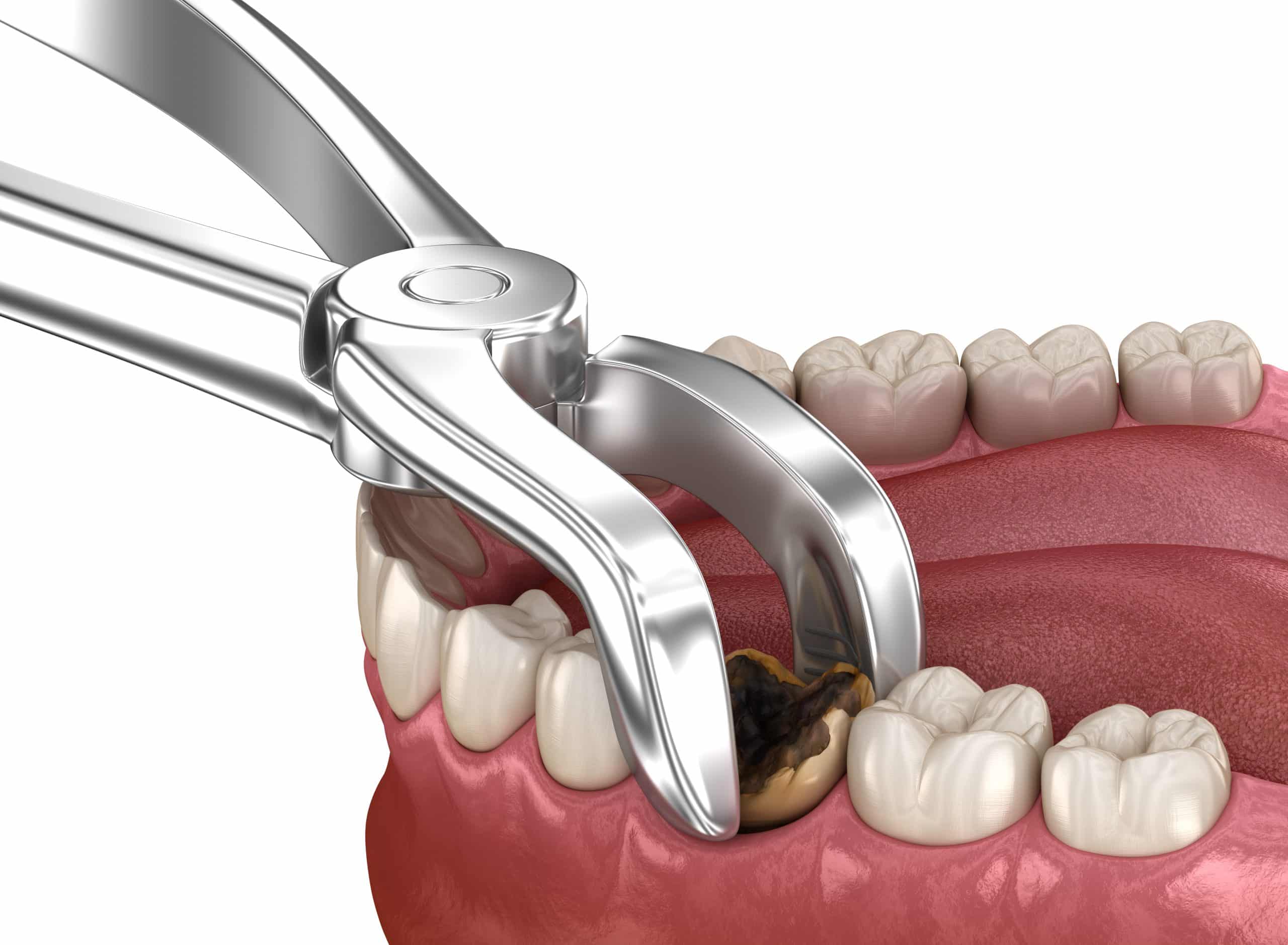 Tooth Extraction in Palm Harbor, FL